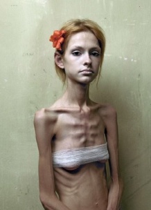 Мировая общественность бьет тревогу: анорексия продолжает убивать